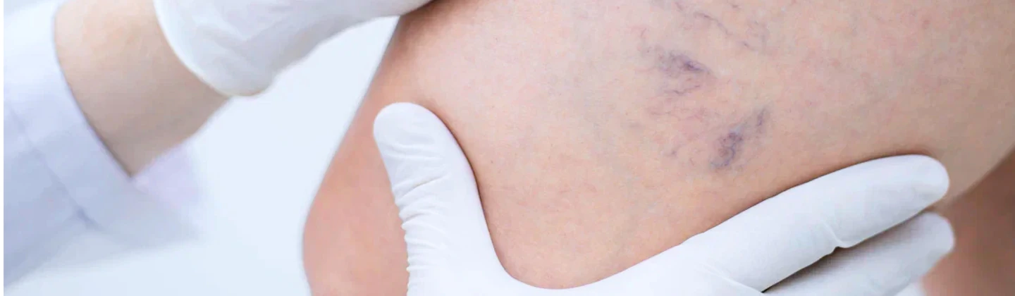 Флеболог в Красноярске