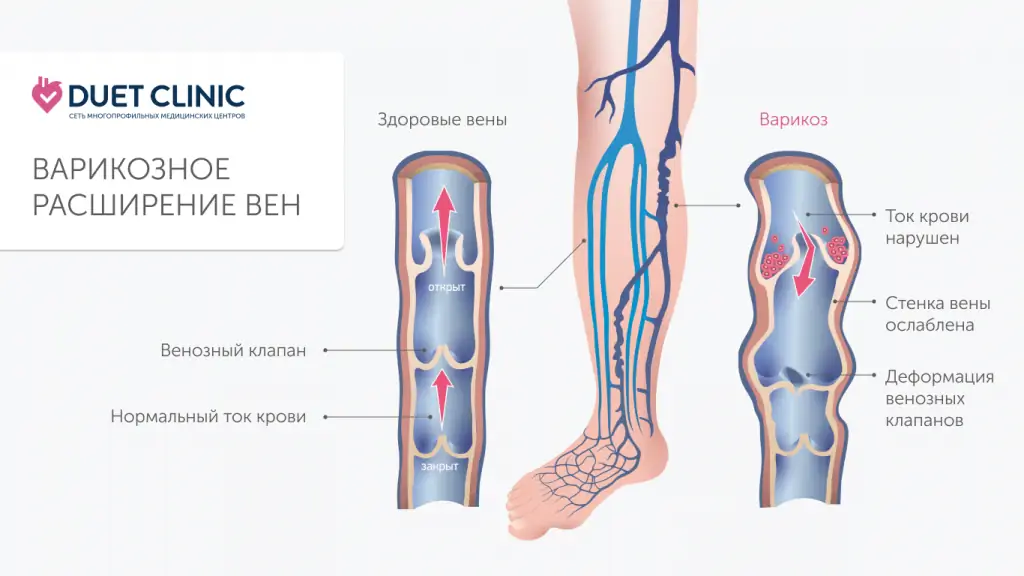 Лазерное лечение варикоза (ЭВЛК) Лазерное лечение варикоза (ЭВЛК)