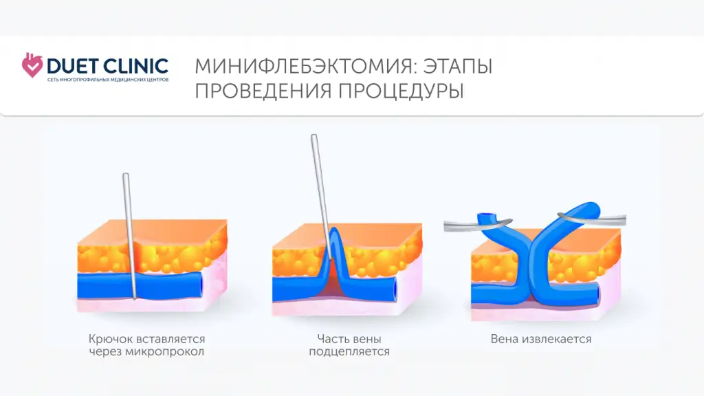 Операция при варикозе