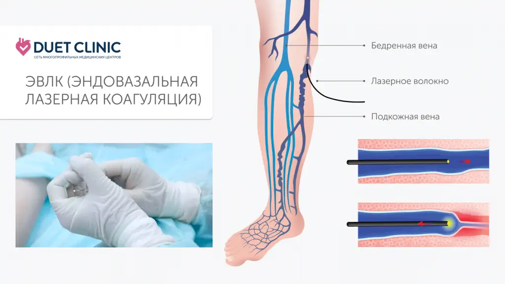 Операция при варикозе