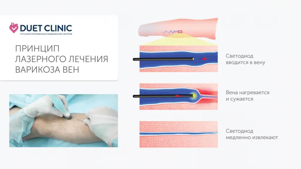 Лазерное лечение варикоза (ЭВЛК) Лазерное лечение варикоза (ЭВЛК)